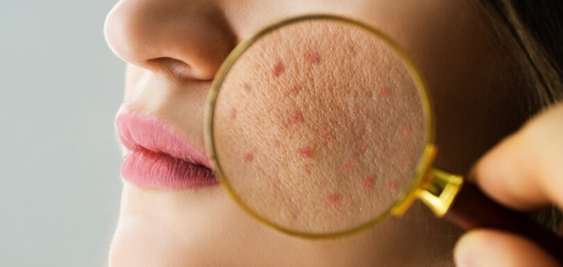 Acne and pimple treatment in Hyderabad at expert skin care clinic
